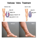 Varicose Cream